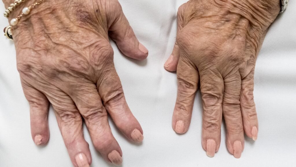 Que es la artritis? Sintomas y tratamiento